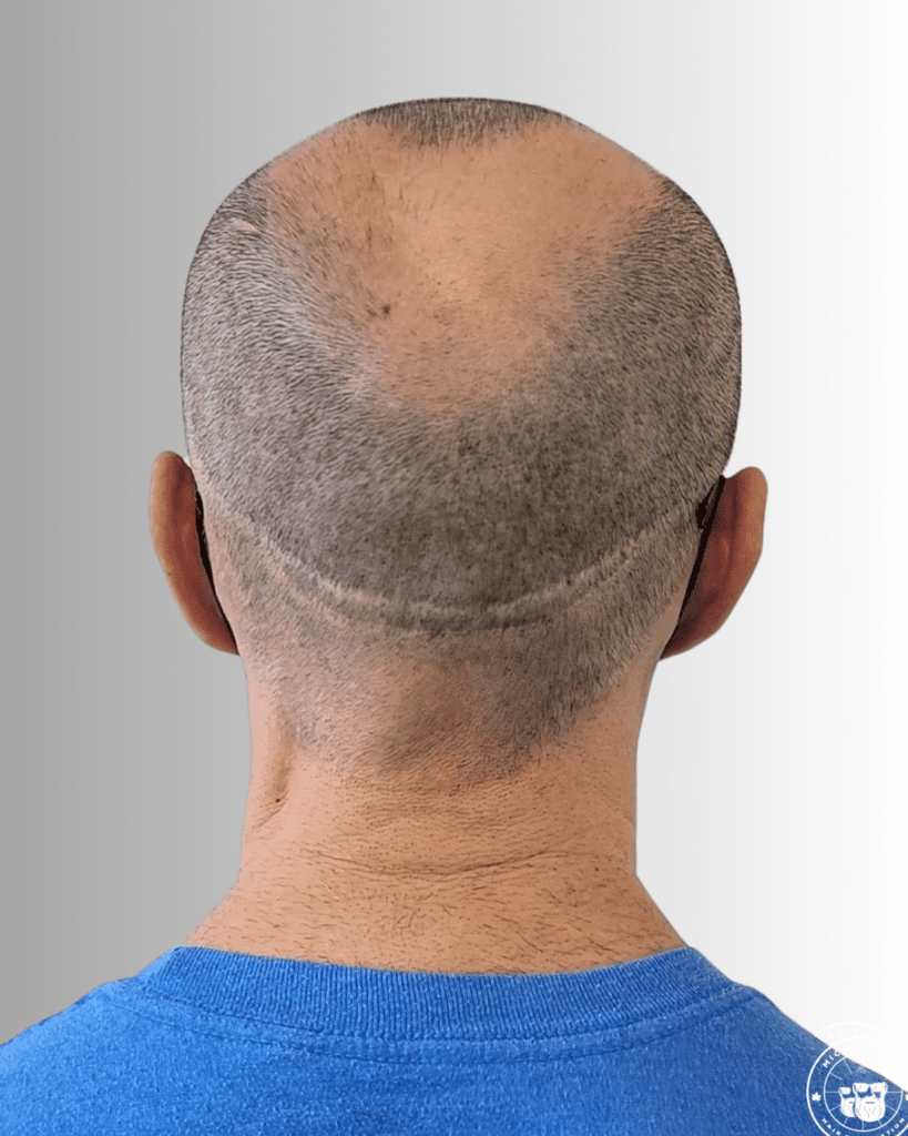 SMP HAIR TRANSPLANT